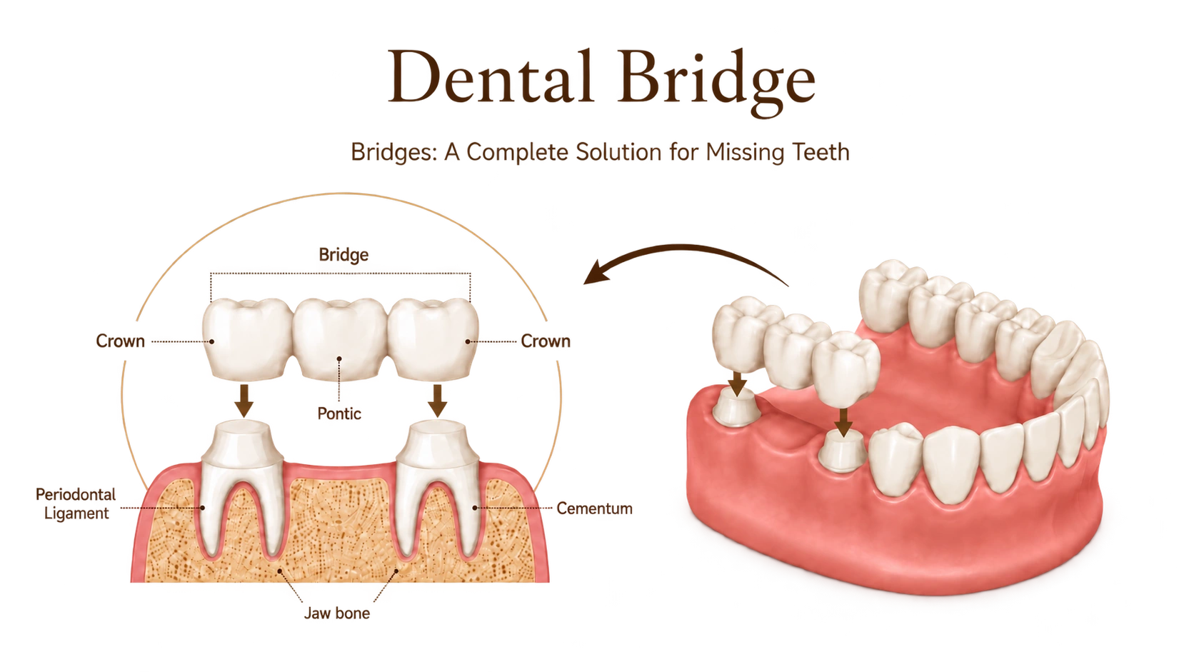 Dental bridge diagram